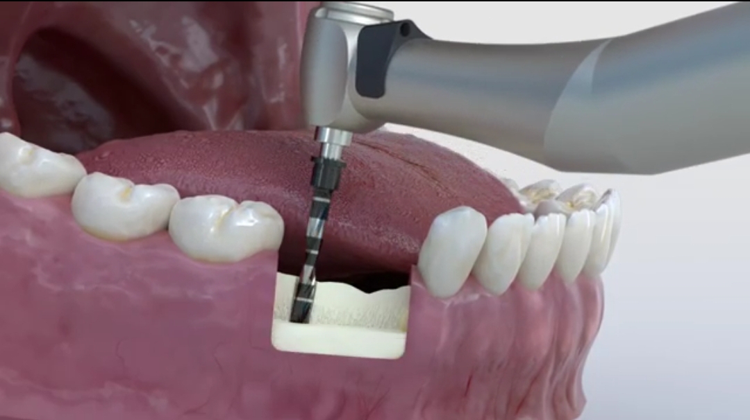 نحوه جایگذاری ایمپلنت سیستم GMI-ILERIMPLANT نحوه جایگذاری ایمپلنت سیستم GMI-ILERIMPLANT