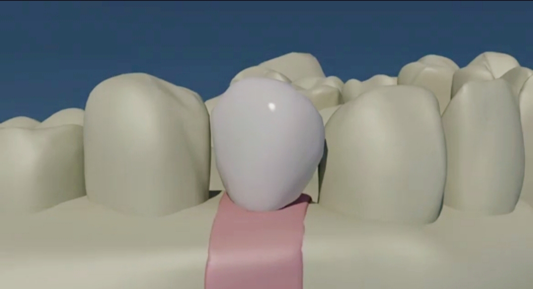 قالبگیری OPEN TRAY و ساخت کراون قالبگیری OPEN TRAY و ساخت کراون