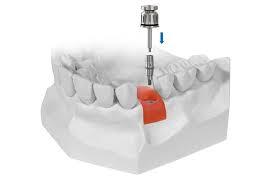 قالبگیری دیجیتال قالبگیری دیجیتال